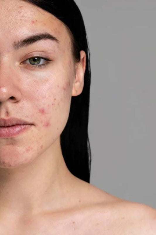 Et si on apprenait à aimer sa peau, même avec des imperfections ?
